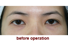 plastic-surgery-blepharoplasty